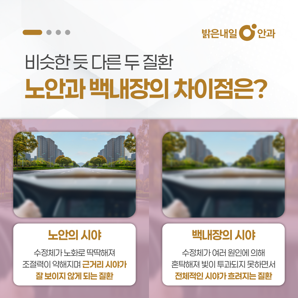 은평구 백내장 안내 이미지 2 - 수정체 혼탁과 시야 변화
