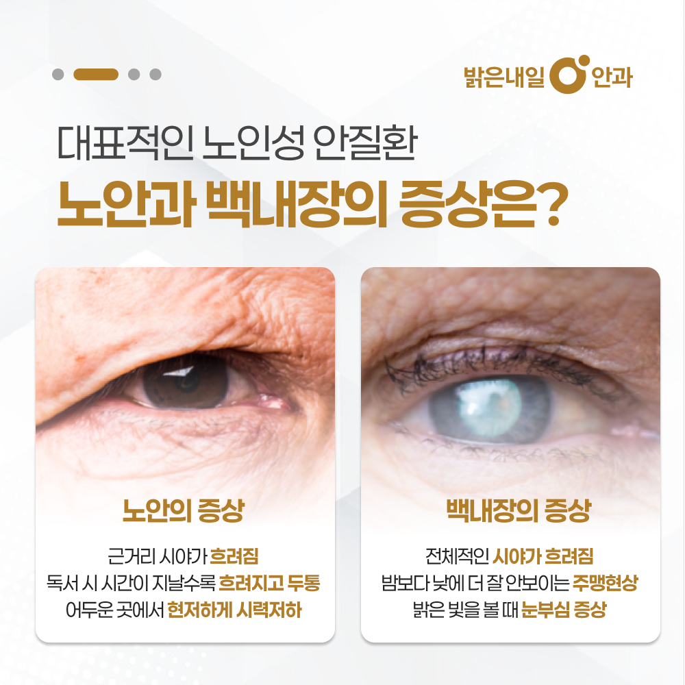 은평구 백내장 안내 이미지 3 - 인공수정체 종류 비교