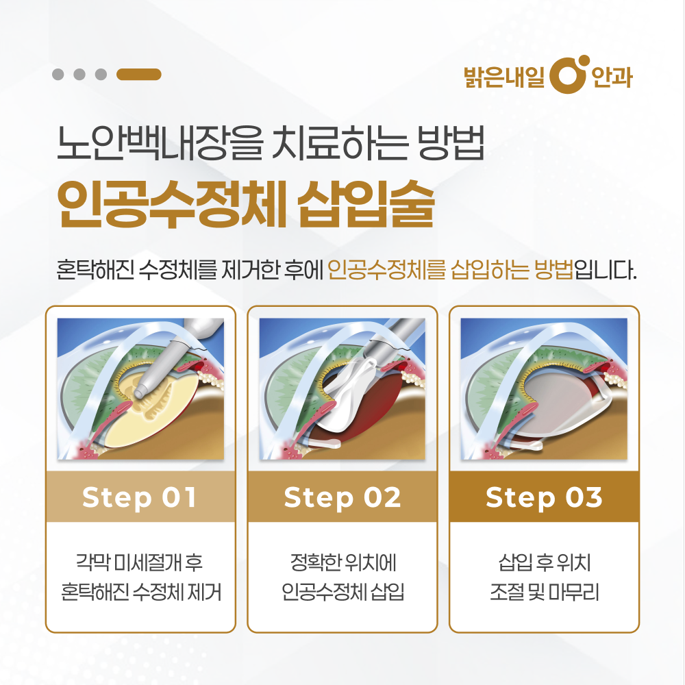 은평구 백내장 안내 이미지 5 - 수술 후 회복과 정기검진