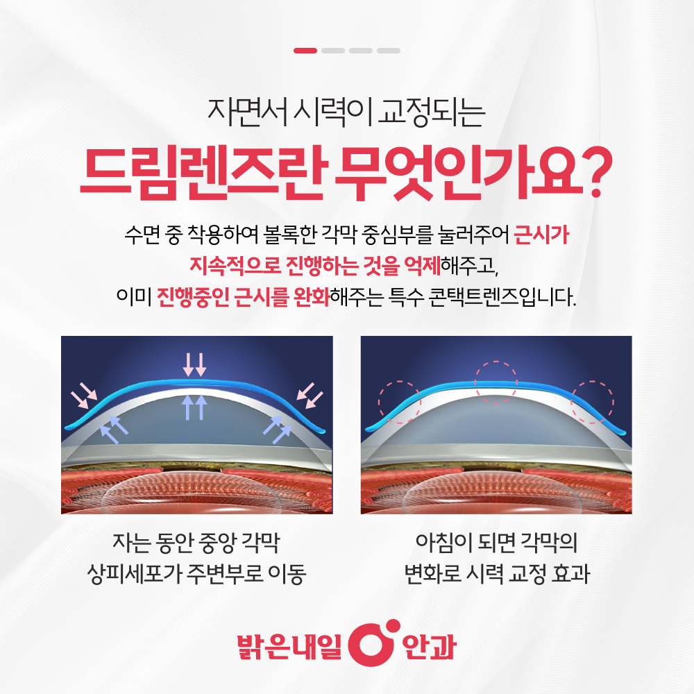 은평구 드림렌즈 안내 이미지 2 - 수면 중 각막교정 원리