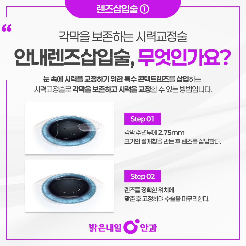 은평구 렌즈삽입술 안내 이미지 2 - 안내렌즈삽입술 원리와 절개창