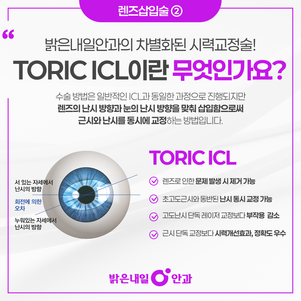 은평구 렌즈삽입술 안내 이미지 3 - TORIC ICL 난시 축 정렬